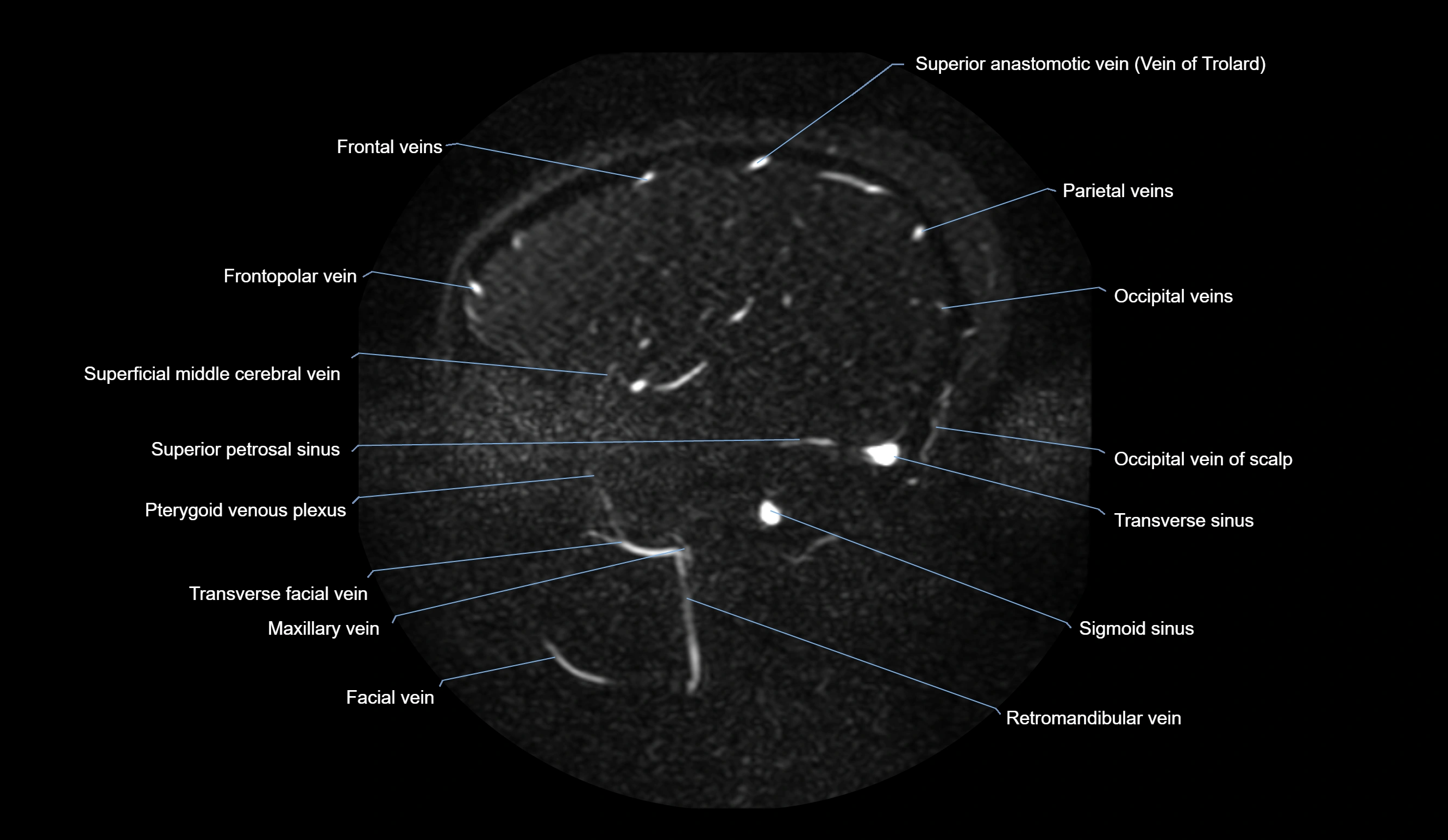 MRV brain sagittal anatomy 3T MRI images -img-01015-00063.webp